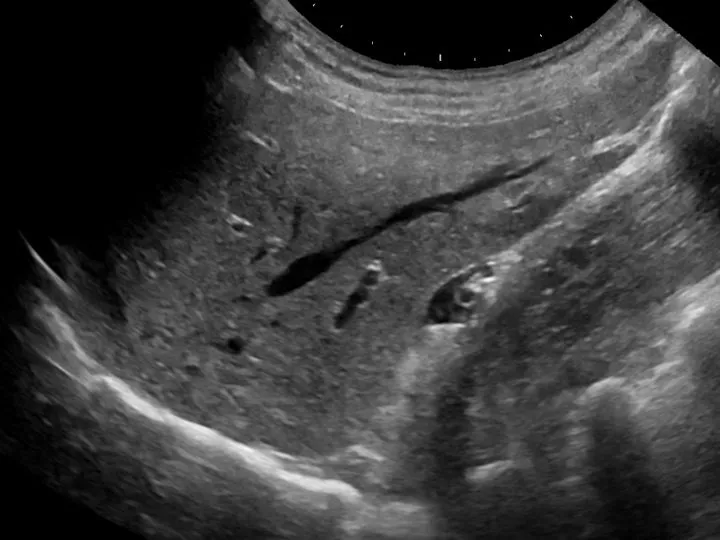 Ultrasound of a normal liver